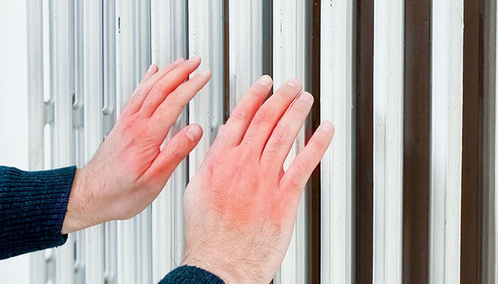 A person’s hands showing redness and swelling, possibly due to Chilblains, a common cold-induced skin condition, highlighting the contrast between ACLS and Chilblains in medical care